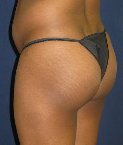 Buttock Lift Gallery - Patient 4861774 - Image 1