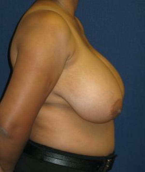 Breast Reduction Gallery - Patient 4861773 - Image 3