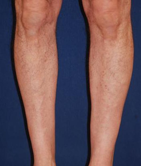 Calf Augmentation with Implants Gallery - Patient 4861776 - Image 3