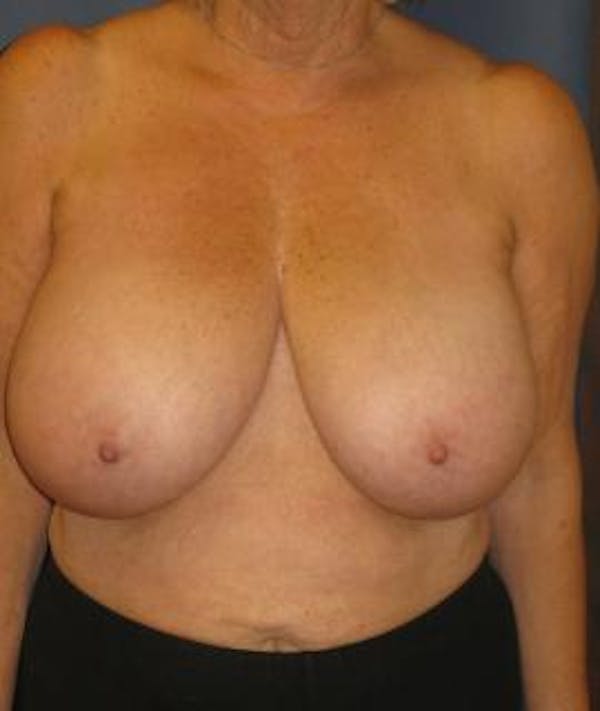 Breast Reduction Gallery - Patient 4861778 - Image 1
