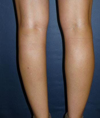 Calf Implants in Houston