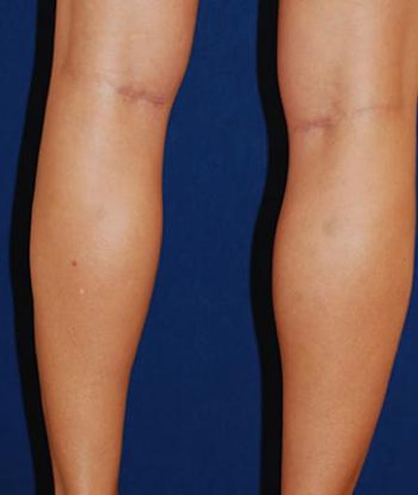 Calf Augmentation with Implants Gallery - Patient 4861777 - Image 2
