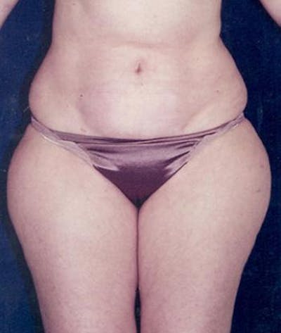Liposuction Gallery - Patient 4861779 - Image 1