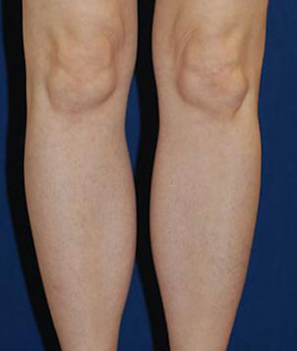 Calf Augmentation with Implants Gallery - Patient 4861780 - Image 2