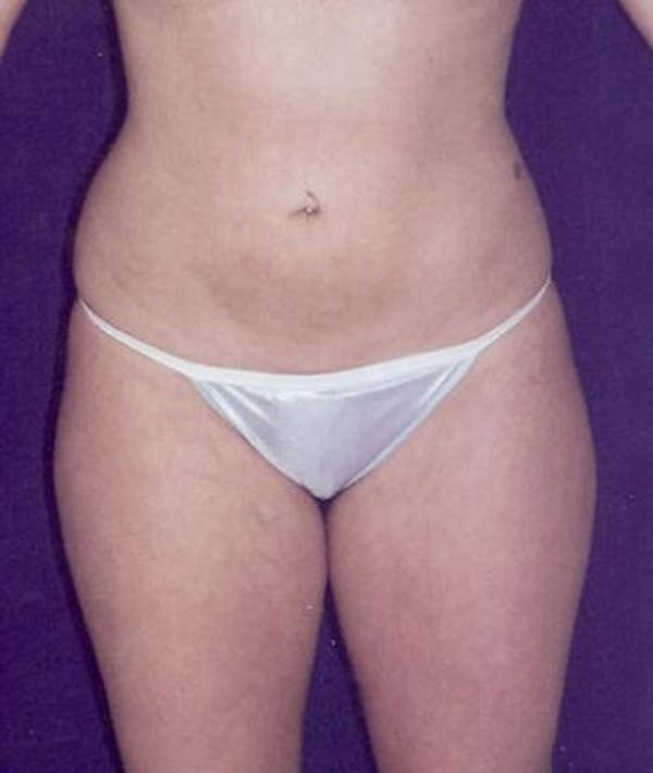 Liposuction Gallery - Patient 4861783 - Image 2