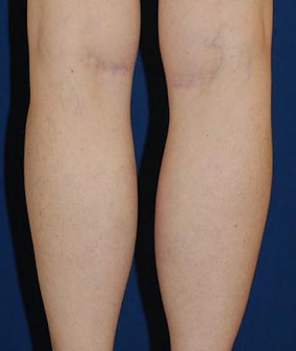 Calf Augmentation with Implants Gallery - Patient 4861780 - Image 4