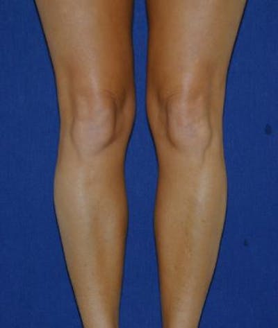 Calf Augmentation with Implants Gallery - Patient 4861784 - Image 1