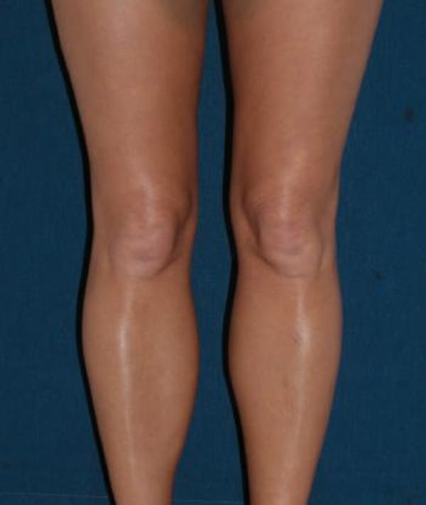Calf Augmentation with Implants Gallery - Patient 4861784 - Image 2