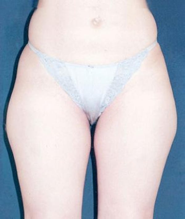 Liposuction Gallery - Patient 4861785 - Image 1