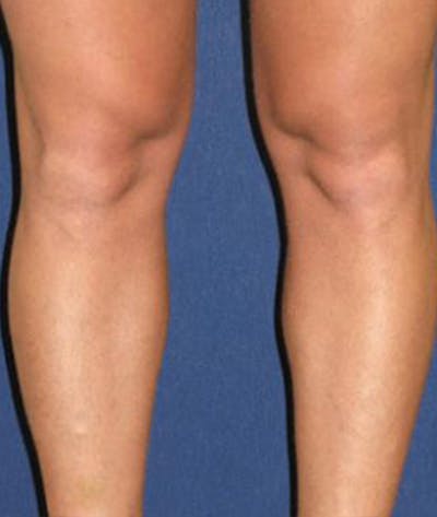 Calf Augmentation with Implants Gallery - Patient 4861794 - Image 1