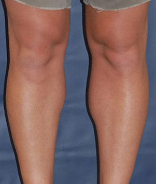 Calf Augmentation with Implants Gallery - Patient 4861794 - Image 2