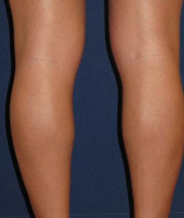 Calf Augmentation with Implants Gallery - Patient 4861794 - Image 3