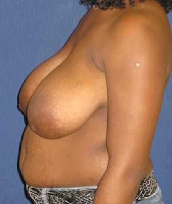 Breast Reduction Gallery - Patient 4861795 - Image 3