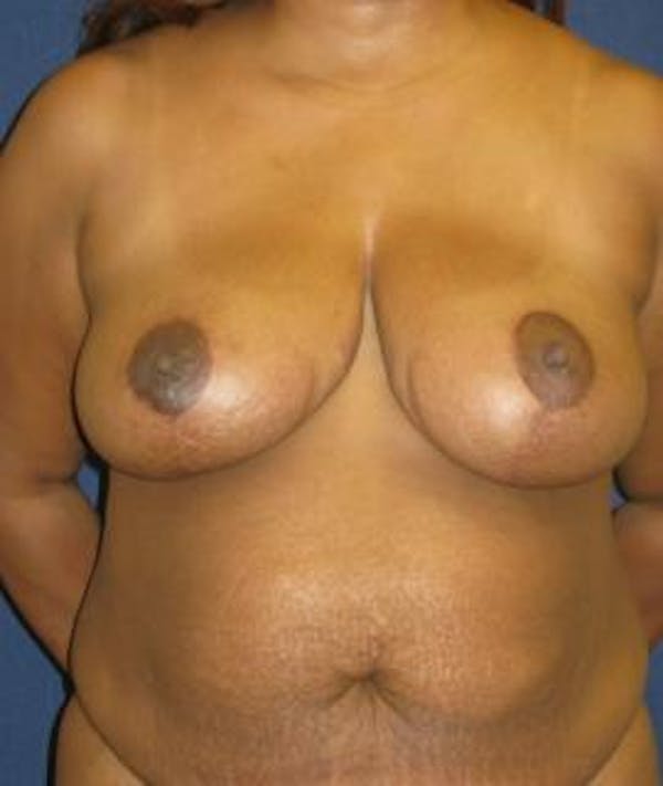 Breast Reduction Gallery - Patient 4861798 - Image 2