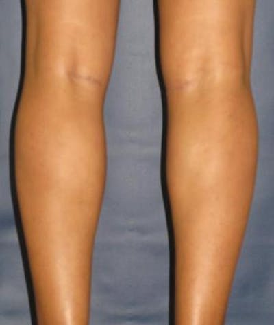 Calf Augmentation with Implants Gallery - Patient 4861797 - Image 4