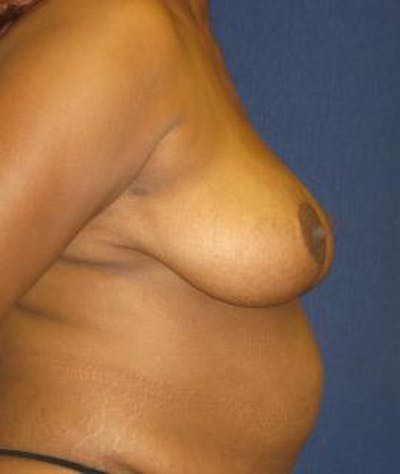 Breast Reduction Gallery - Patient 4861798 - Image 4