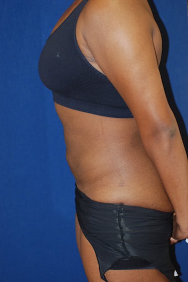 Liposuction Gallery - Patient 4861799 - Image 2