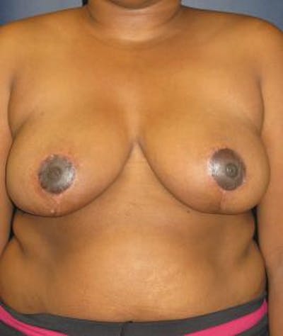 Breast Reduction Gallery - Patient 4861801 - Image 2