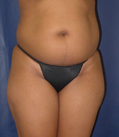 Liposuction Gallery - Patient 4861802 - Image 1