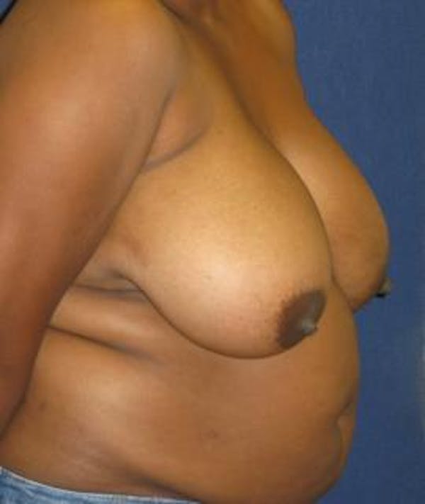 Breast Reduction Gallery - Patient 4861801 - Image 3