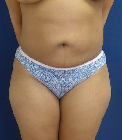 Liposuction Gallery - Patient 4861802 - Image 2