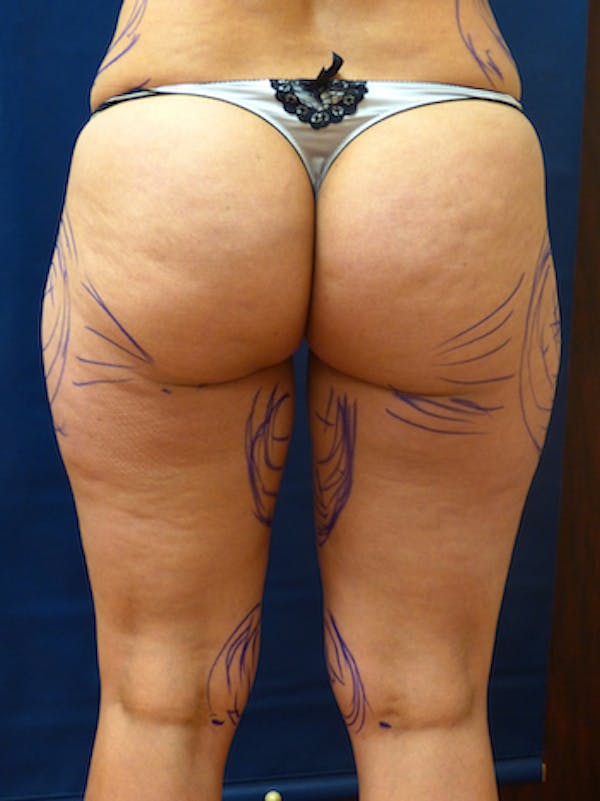 Liposuction Gallery - Patient 4861804 - Image 3