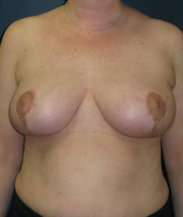 Breast Reduction Gallery - Patient 4861806 - Image 2
