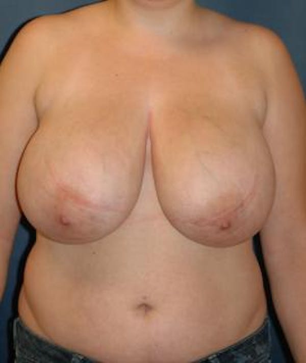 Breast Reduction Gallery - Patient 4861814 - Image 1