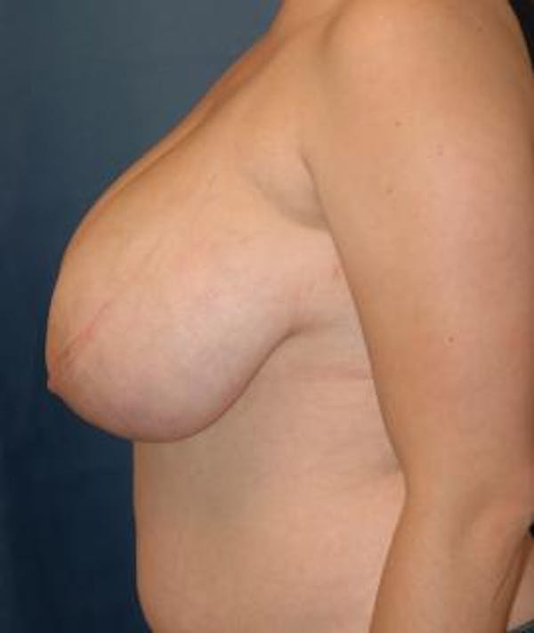 Breast Reduction Gallery - Patient 4861814 - Image 3