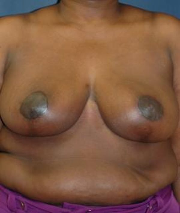 Breast Reduction Gallery - Patient 4861816 - Image 2