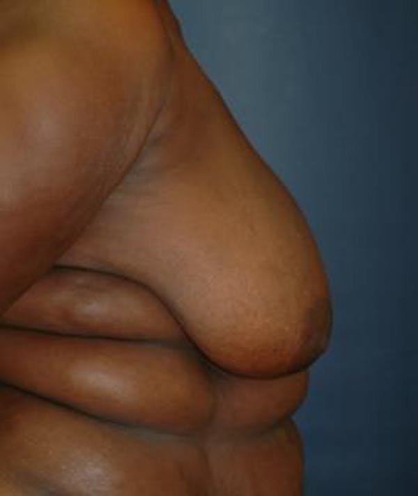 Breast Reduction Gallery - Patient 4861816 - Image 3