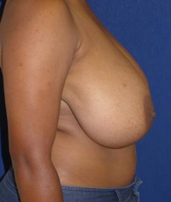 Breast Reduction Gallery - Patient 4861818 - Image 3