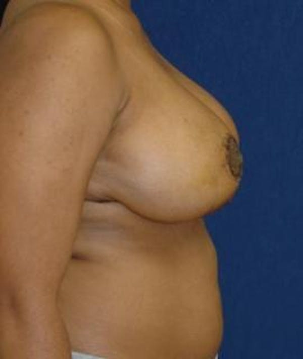 Breast Reduction Gallery - Patient 4861818 - Image 4