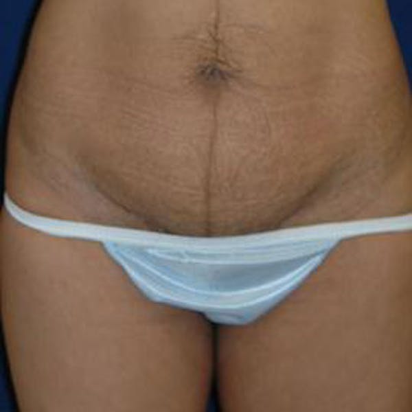 Tummy Tuck (Abdominoplasty) Gallery - Patient 4861819 - Image 1