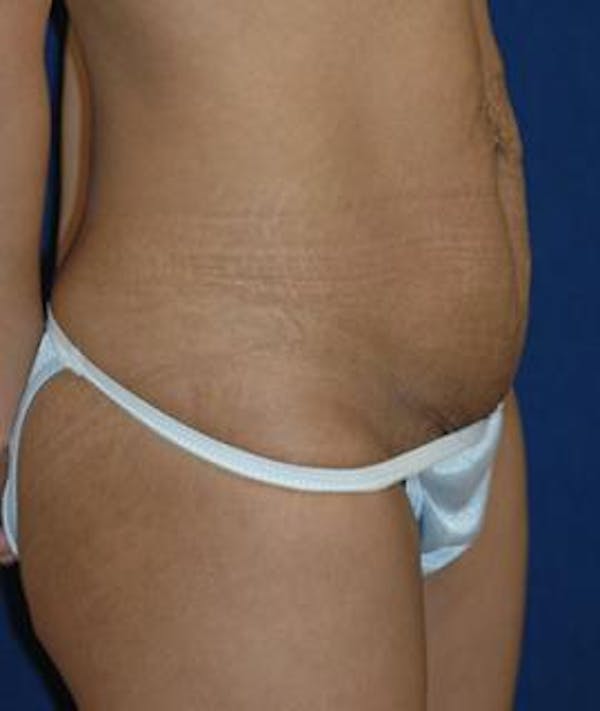 Tummy Tuck (Abdominoplasty) Gallery - Patient 4861819 - Image 3