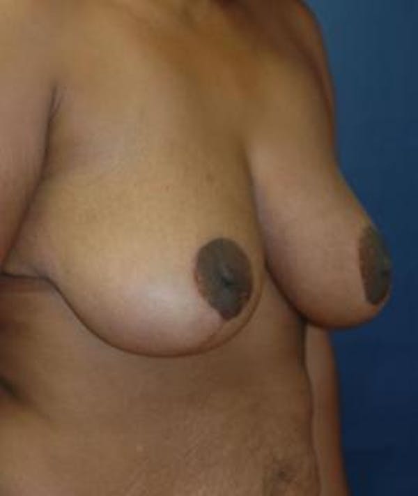 Breast Reduction Gallery - Patient 4861820 - Image 2