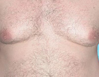 Male Subcutaneous Mastectomy (Gynecomastia) Gallery - Patient 4861821 - Image 1