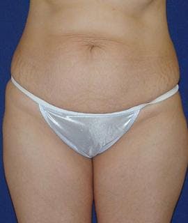 Houston Tummy Tuck Before and After