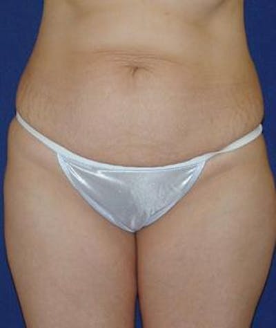 Tummy Tuck (Abdominoplasty) Gallery - Patient 4861822 - Image 1