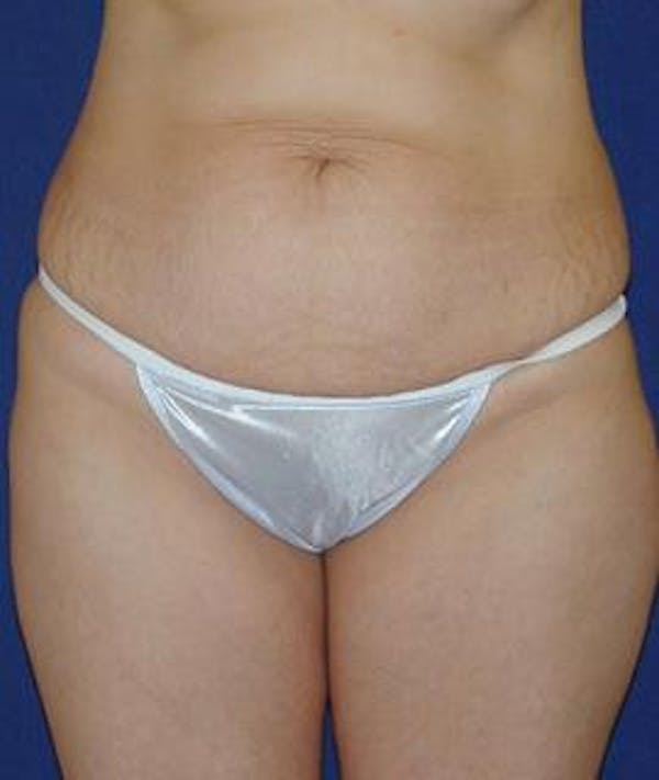 Tummy Tuck (Abdominoplasty) Gallery - Patient 4861822 - Image 1