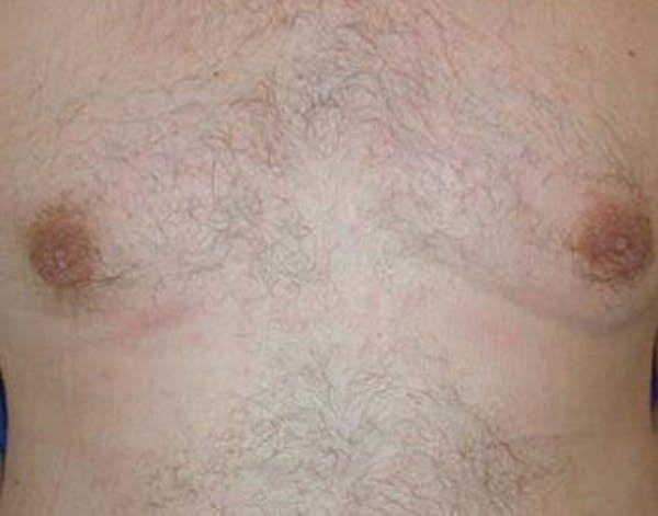 Gynecomastia