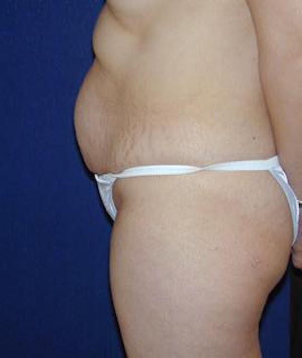 Tummy Tuck (Abdominoplasty) Gallery - Patient 4861822 - Image 3