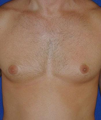 Gynecomastia