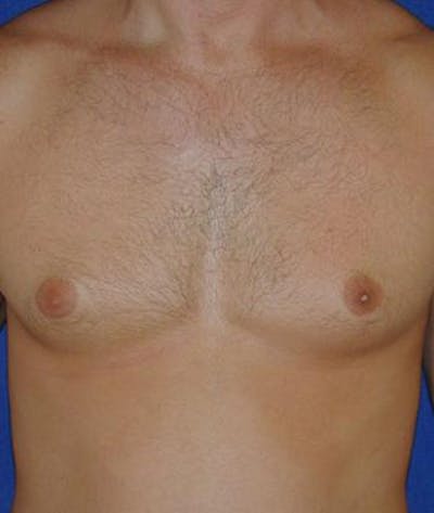 Male Subcutaneous Mastectomy (Gynecomastia) Gallery - Patient 4861824 - Image 1