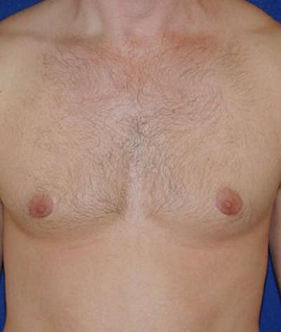 Male Subcutaneous Mastectomy (Gynecomastia) Gallery - Patient 4861824 - Image 2