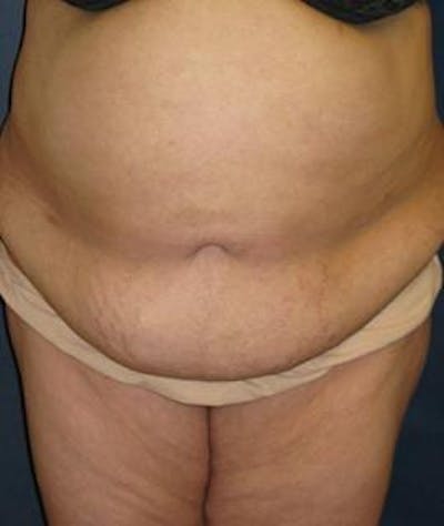 Tummy Tuck (Abdominoplasty) Gallery - Patient 4861825 - Image 1