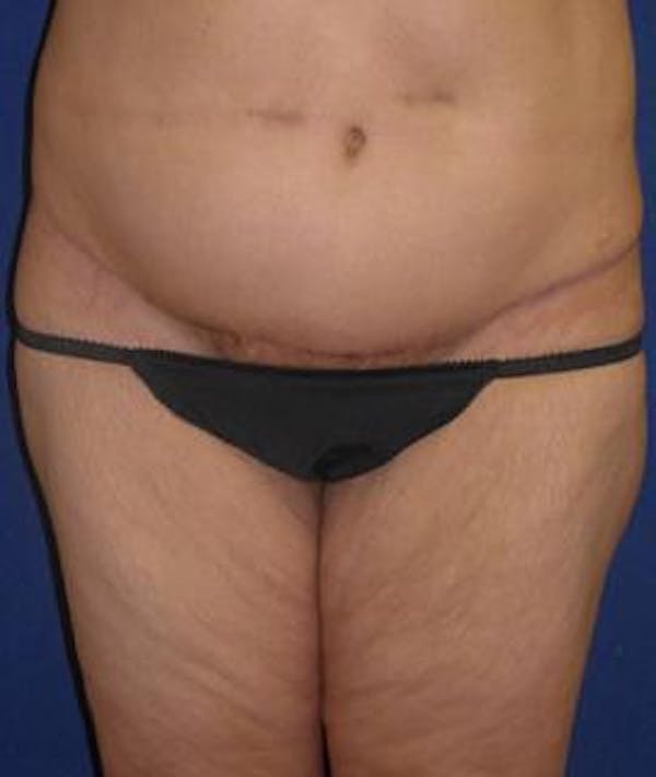 Tummy Tuck (Abdominoplasty) Gallery - Patient 4861825 - Image 2