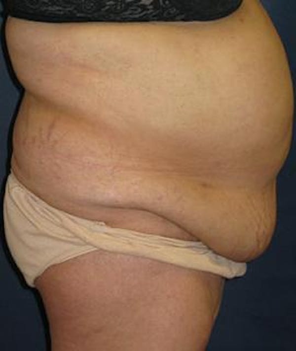 Tummy Tuck (Abdominoplasty) Gallery - Patient 4861825 - Image 3