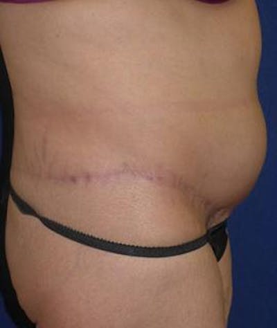 Tummy Tuck (Abdominoplasty) Gallery - Patient 4861825 - Image 4