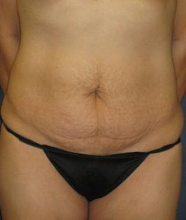 Tummy Tuck (Abdominoplasty) Gallery - Patient 4861888 - Image 1